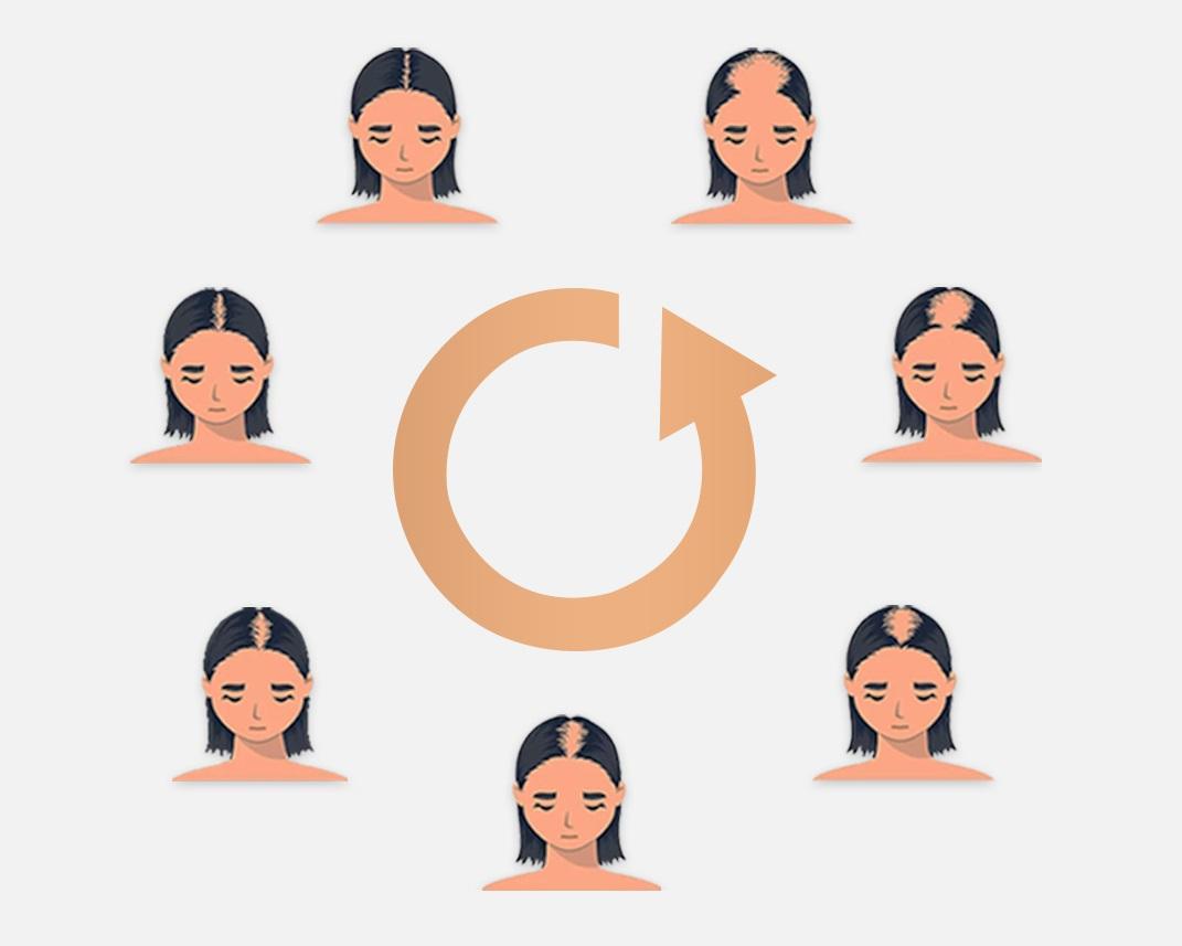Hair Transplant Procedure Female