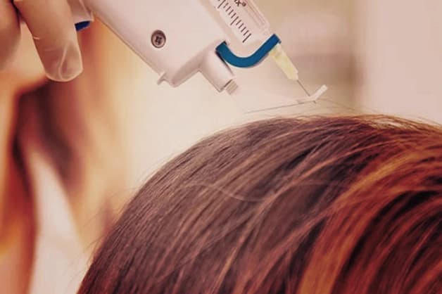 About Mesogun Therapy (Mesotherapy)