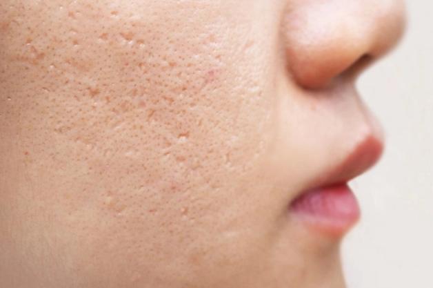 About Acne Scars