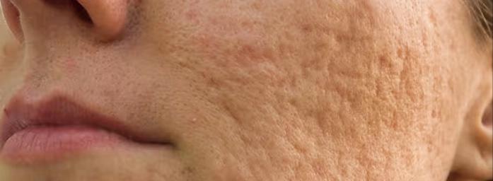 Depression scars