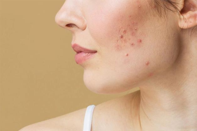 About Acne