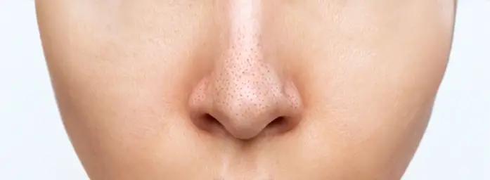 Blackheads