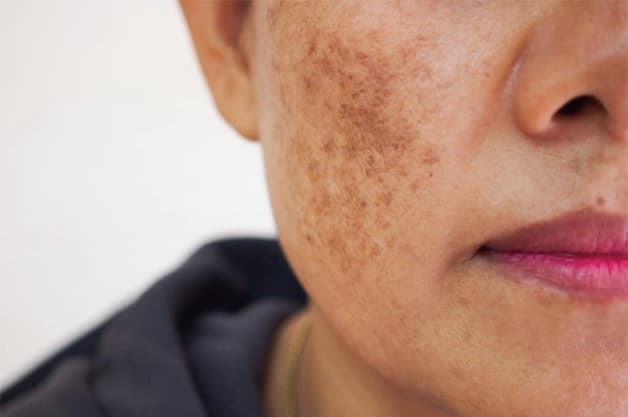 What Exactly the Pigmentation Concern is?