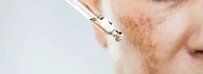 Hyperpigmentation