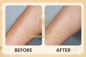 Laser hair removal before & after patient 2