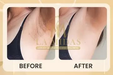 Laser hair reduction before & after patient 3