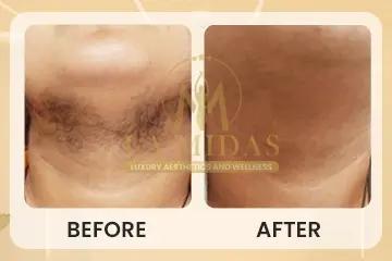 Laser hair removal before & after patient 5