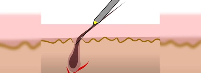 Depilation method