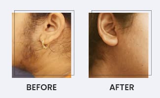 Laser Hair Reduction Before After