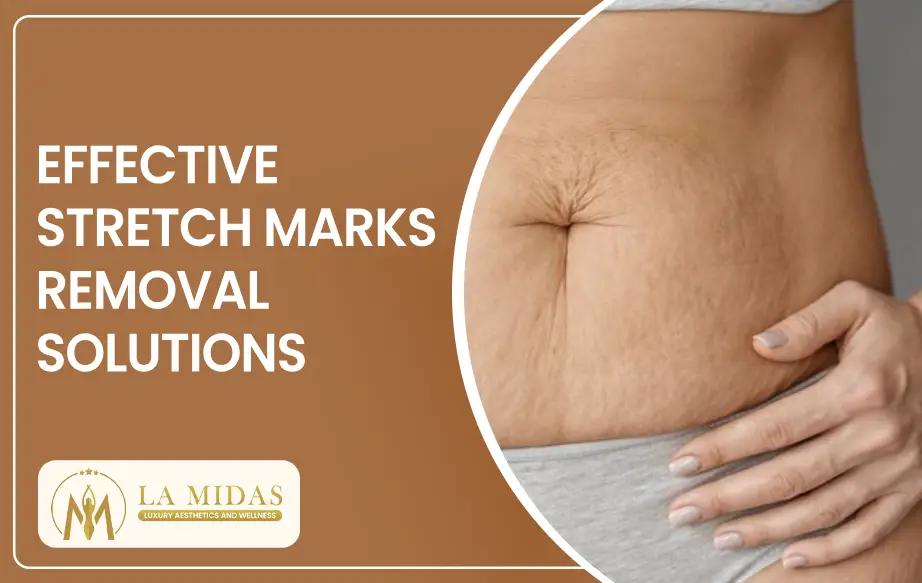 Effective Stretch Marks Removal Solutions