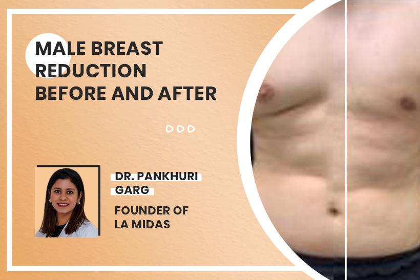 Male Breast Reduction Before And After