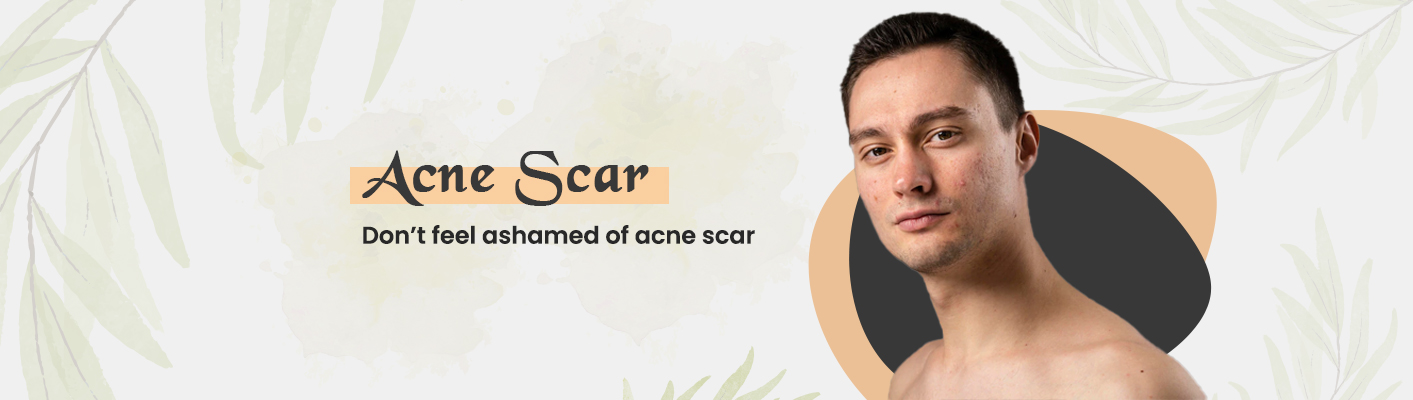 man showing his acne scar