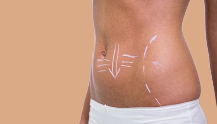 Procedure of Cellulites Removal