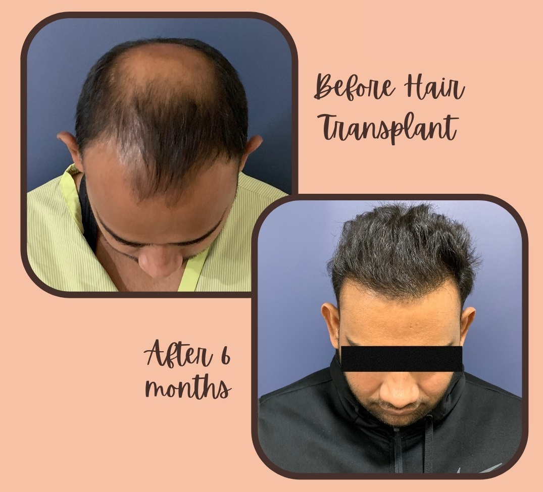Before and after hair transplant result in Gurgaon at La Midas