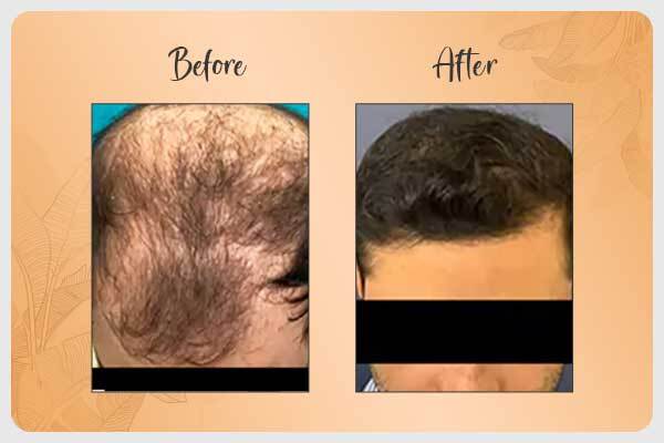Before and After Hair Transplantation in Gurgaon Results