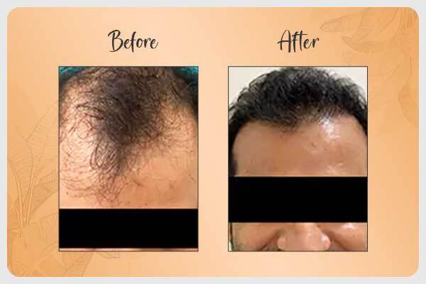 Hair Restoration Before and After Results in Gurgaon