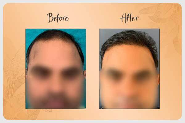 Comparison between results before and after hair restoration surgery