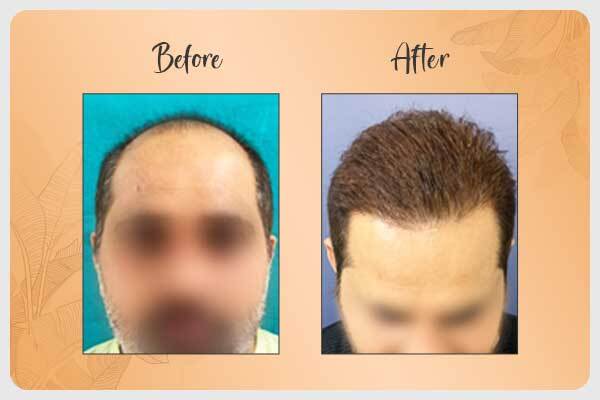 Results after hair transplant surgery in Gurgaon At La Midas