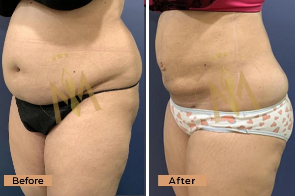 Before and After Result: Stomach Liposuction Surgery Result at La Midas Gurgaon