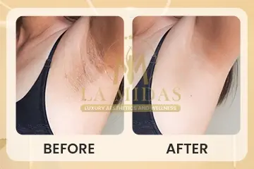 Laser hair removal before & after patient 2