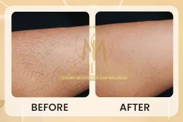 Laser hair reduction before & after patient 3