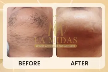 Laser hair removal before & after patient 5