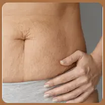 Effective Stretch Marks Removal Solutions